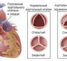 Stenoză aortică
