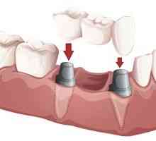 Dispozitive dentare: poduri, proteze partiale si complete amovibile