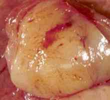 Stomac tumorale stromale gastrointestinale (GIST, hist)