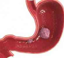 Tumorile stromale ale tractului gastro-intestinal: simptome, tratament, simptome