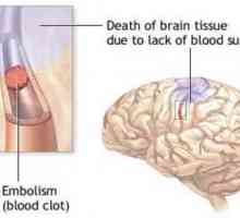Subarahnoidiană hemoragie, consecințe, tratament, simptome