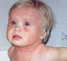 Erupții cutanate la un copil la un disbacterioza