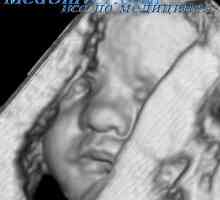 Managementul clinic al fetusi cu retard de creștere intrauterină. EXEMPLU Delay creșterea…