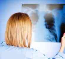 Sindromul respirator acut sever