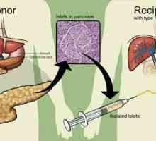Transplantul de pancreas