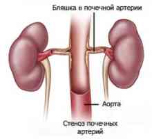 Tromboza arterelor renale