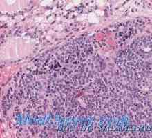 Tuberculoza a morfologiei tiroidiene, anatomie patologică