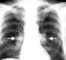 Tuberculoza ganglionilor limfatici intratoracice: tratament, complicații, cauze, simptome