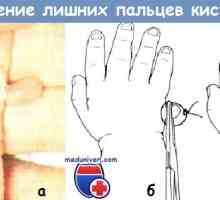 Eliminarea degetele de la picioare indicații suplimentare, contraindicații, tehnica