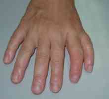 Dublarea primul deget (sau fascicul preaxial polidactilie)