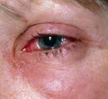 Vanatai si ochi ranit: tratament, prim ajutor, cauze, simptome, semne