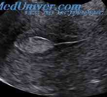 Uzi uterine tuburi. ligamente Transvaginal rotunde cu ultrasunete și intestine