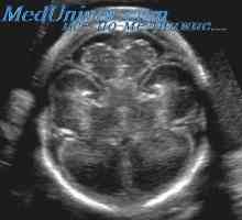 Ingrijire prenatala cu Ventriculomegalie. hidrocefalie congenitală