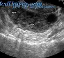 Tipuri de sarcină extrauterină. Localizarea sarcinii ectopice