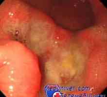 Efectul durerii asociate cu ulcer peptic asupra sintezei de glucocorticoizi