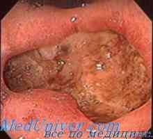 Impactul glandelor endocrine în trofiku stomac