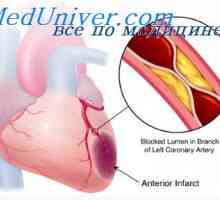 Fibrilație ventriculară după infarct miocardic. ruptură ventriculara peretelui miocardic în zona