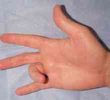 Restaurarea degetelor tendoane flexoare