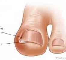 Unghii incarnate pe picior: tratament, cauze, simptome, semne