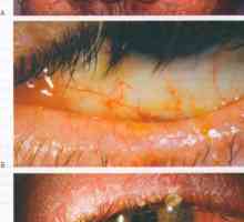 Boli ale rozacee oculară conjunctivă