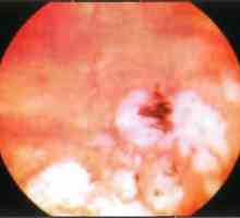 Boli ale periferiei retinei: degenerare a retinei de „caldarîm“ de tip