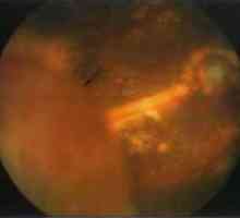 Boli ale periferiei retinei: dezlipire de retina exudativă
