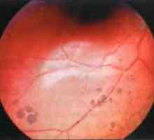 Boli ale periferiei retiniene: pigmentarea grupată periferice
