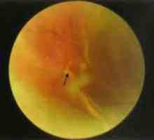 Boli ale periferiei retinei: dezlipire regmatogenă. Epidemiologie si etiologie, istorie, semne