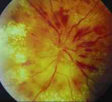 Disc optic congestive cu sindrom hipertensiune hidrocefalie