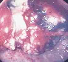 Cancerul de stomac glandulara