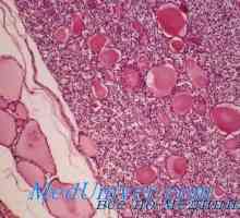 Neoplasmele maligne ale simptomelor tiroidiene, clasificarea