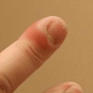 Abcesul degetul