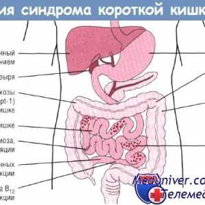 Efectul sindromului de intestin scurt (CCM) asupra tractului gastro-intestinal