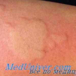 Alergii Adrenostimulyatorov. Anticolinergicele cu reacții alergice