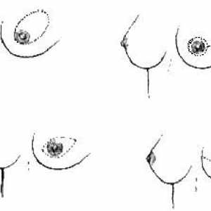 Obstetrică și Ginecologie mastectomie cu conservarea pielii cu reconstructie san simultană