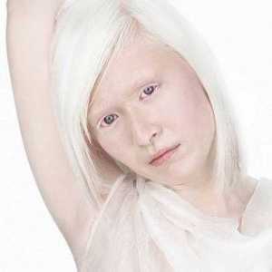 Albinism la om, ochi