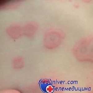 Alergic la sulfonamide. sindrom Stevens-Johnson și necroliza epidermică toxică