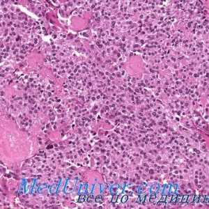 Amiloid de cancer tiroidian. cancer schiros a glandei tiroide