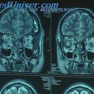 Epilepsie focală. Tratamentul chirurgical al epilepsiei