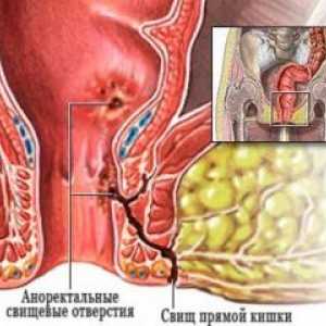 Abces anorectal: tratament, simptomele, cauzele