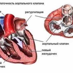 Boli de inima aortică: tratament, simptome, semne, cauze