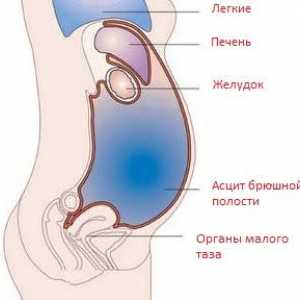 Ascita-peritonită