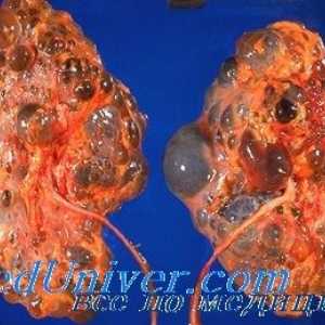Boala autozomal dominanta de rinichi polichistic la copii. Diagnostic si tratament