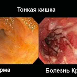 Boala Crohn si colita ulcerativa