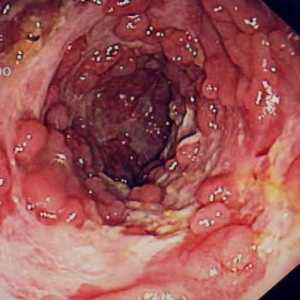 Boala Crohn, cancerul de colon, simptome și tratament