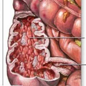 Boala intestinului subtire Crohns