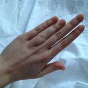 Degetul mare Brachydactyly: cauze, tratament, simptome, semne