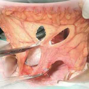 Rezecție abdominală-anală a rectului cu aducerea în jos coajă