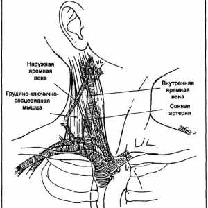 Acces venos central: cateterizarea vena jugulară internă - două acces