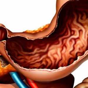 Ce este gastrita anatsidny cronica, simptomele si tratamentul acesteia